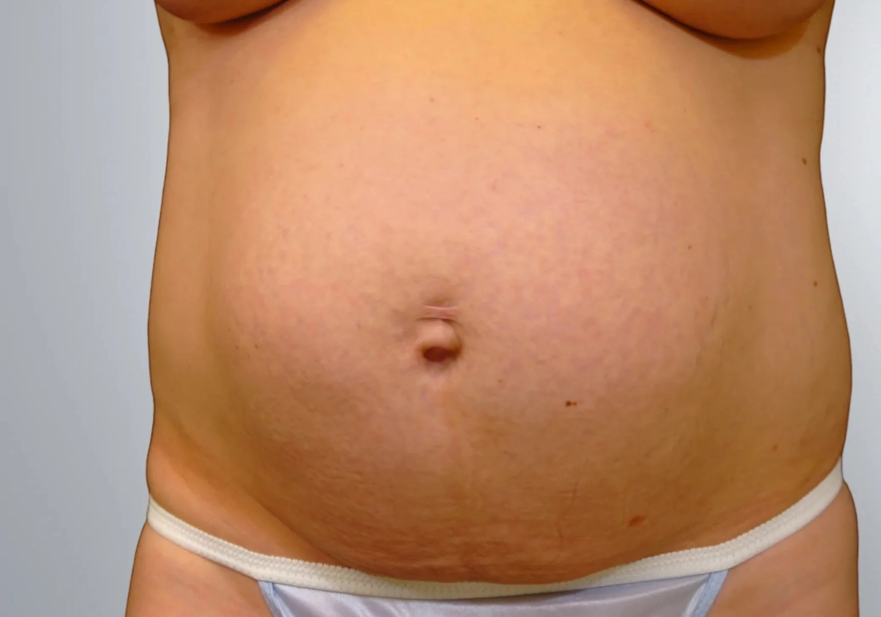 Tummy Tuck before, Edition Plastic Surgery patient