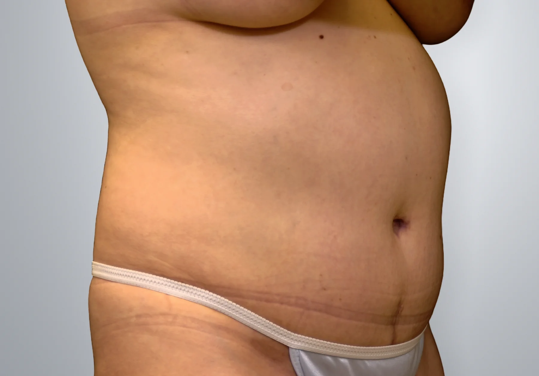 Tummy Tuck after, Edition Plastic Surgery patient