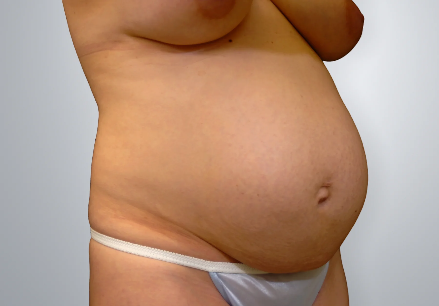 Tummy Tuck before, Edition Plastic Surgery patient
