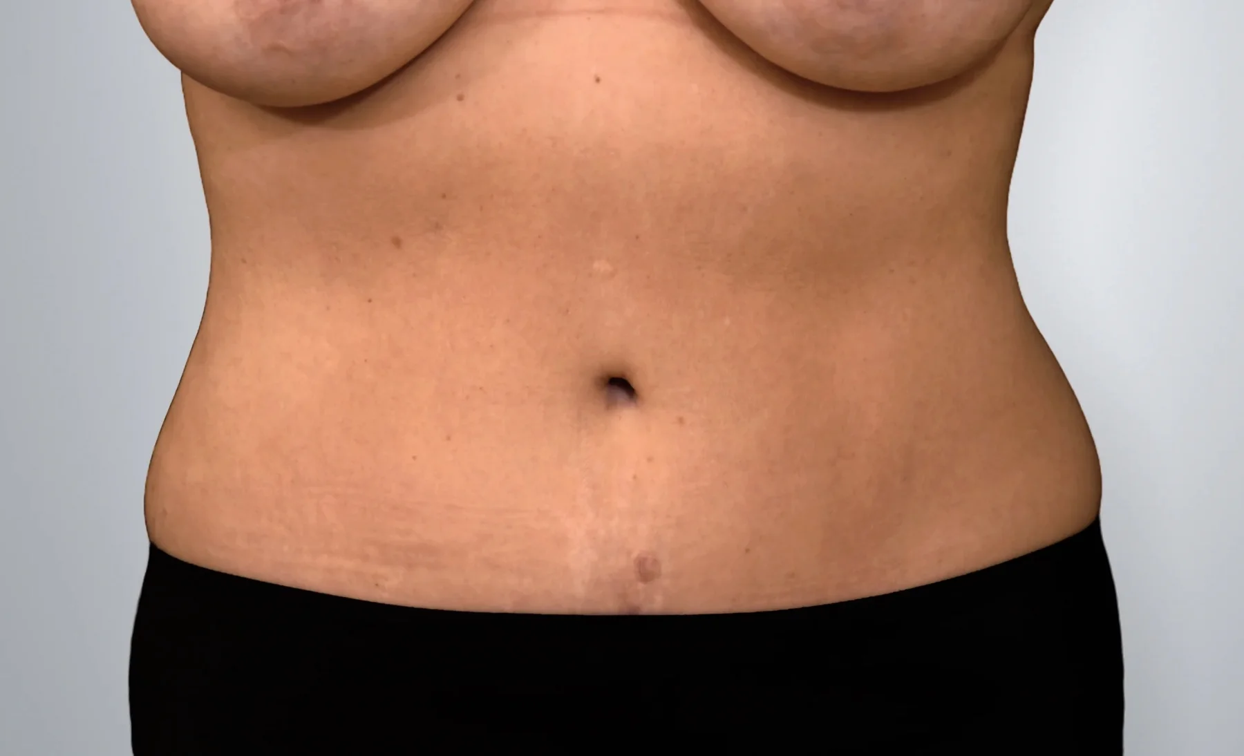 Tummy Tuck after, Edition Plastic Surgery patient