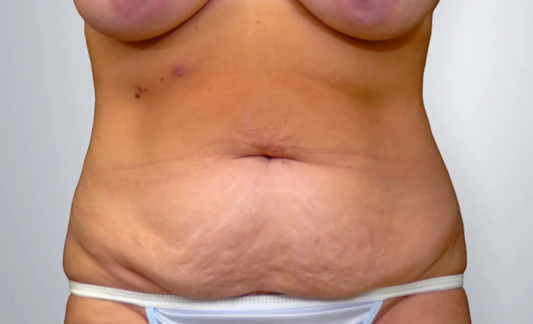 Tummy Tuck before, Edition Plastic Surgery patient