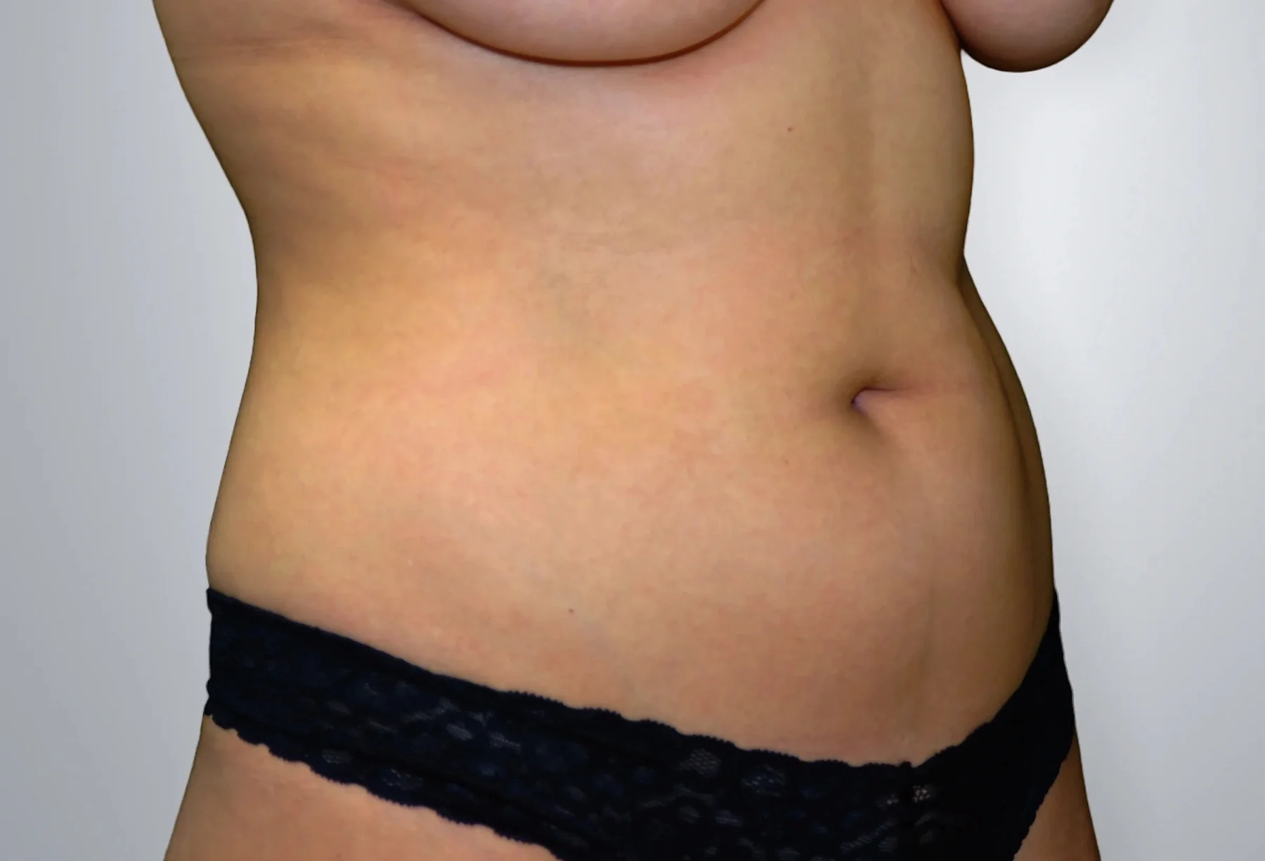 Liposuction before, Edition Plastic Surgery patient