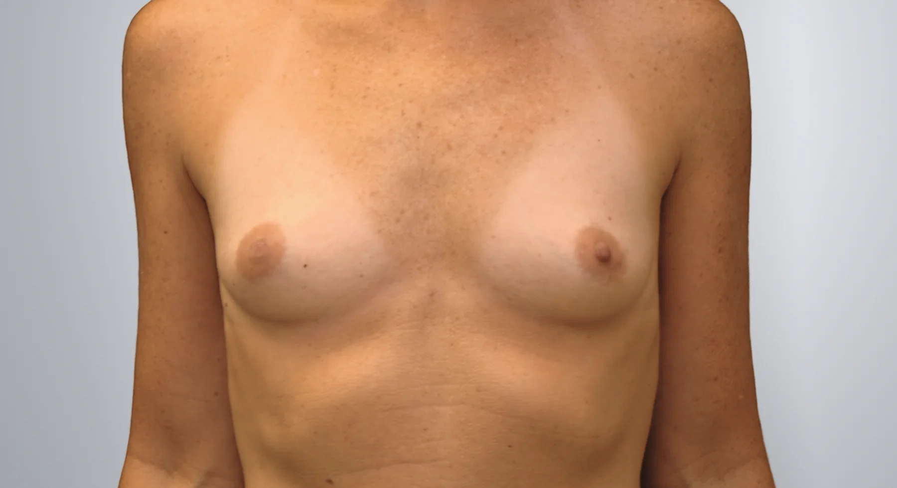 Breast Augmentation before, Edition Plastic Surgery patient