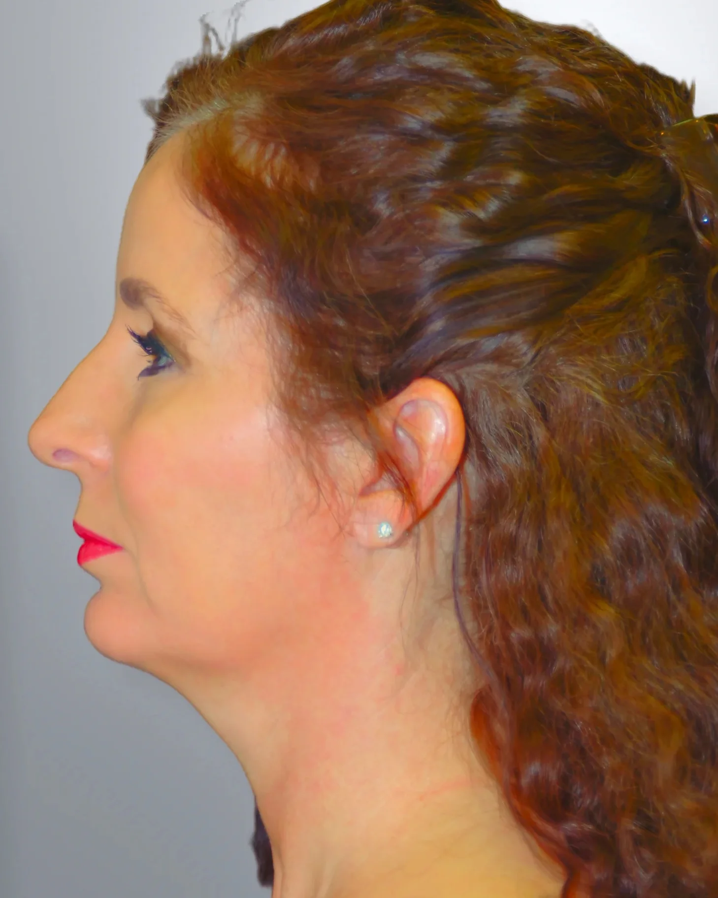 Chin Augmentation + Midface Lift after, Edition Plastic Surgery patient