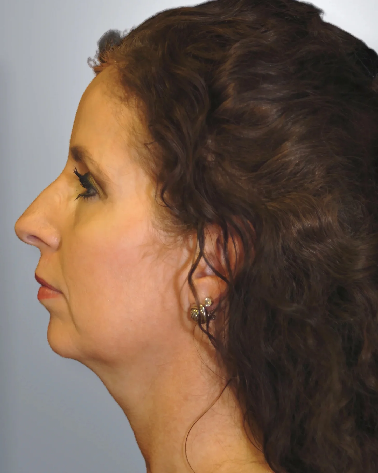 Chin Augmentation + Midface Lift before, Edition Plastic Surgery patient