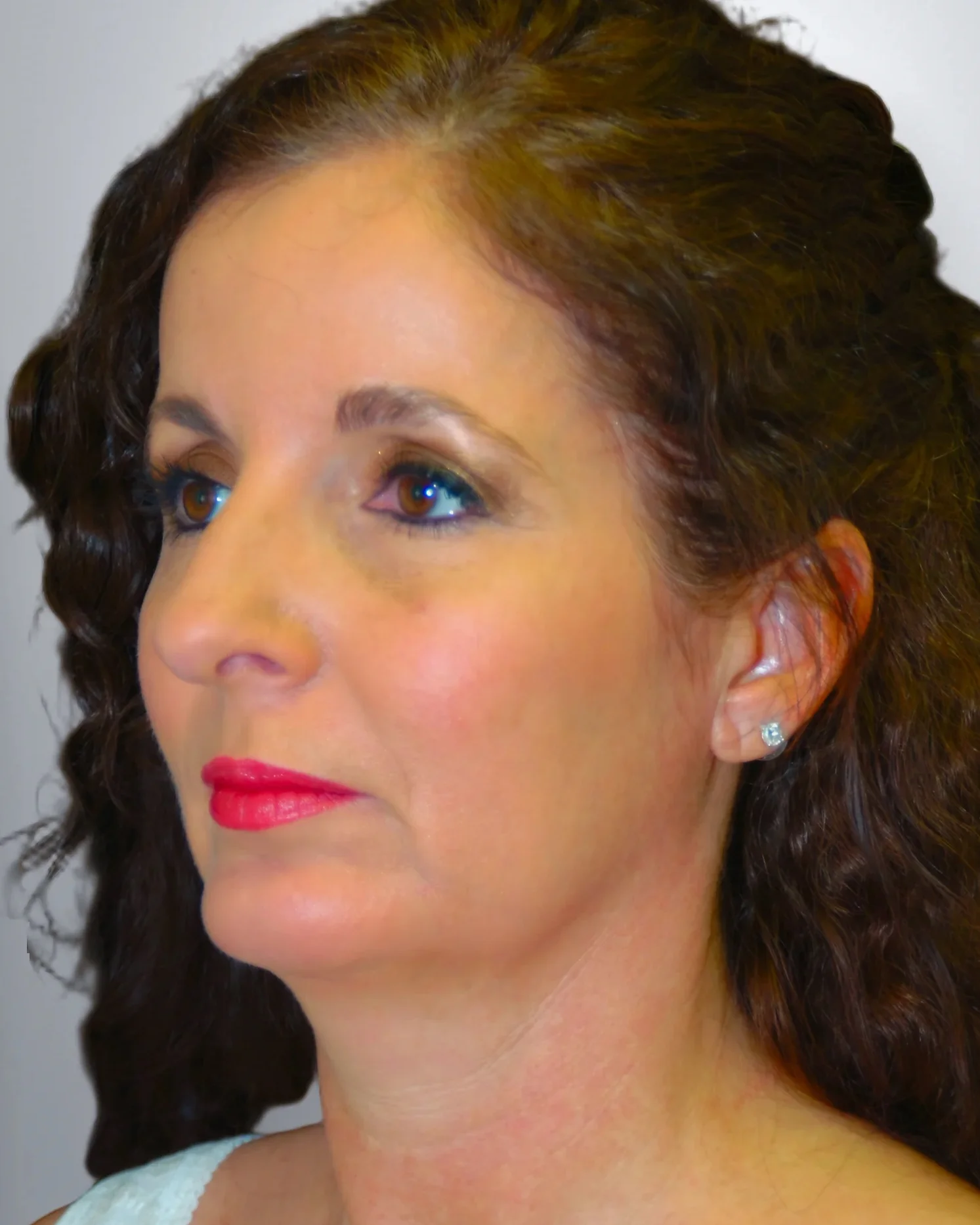 Chin Augmentation + Midface Lift after, Edition Plastic Surgery patient
