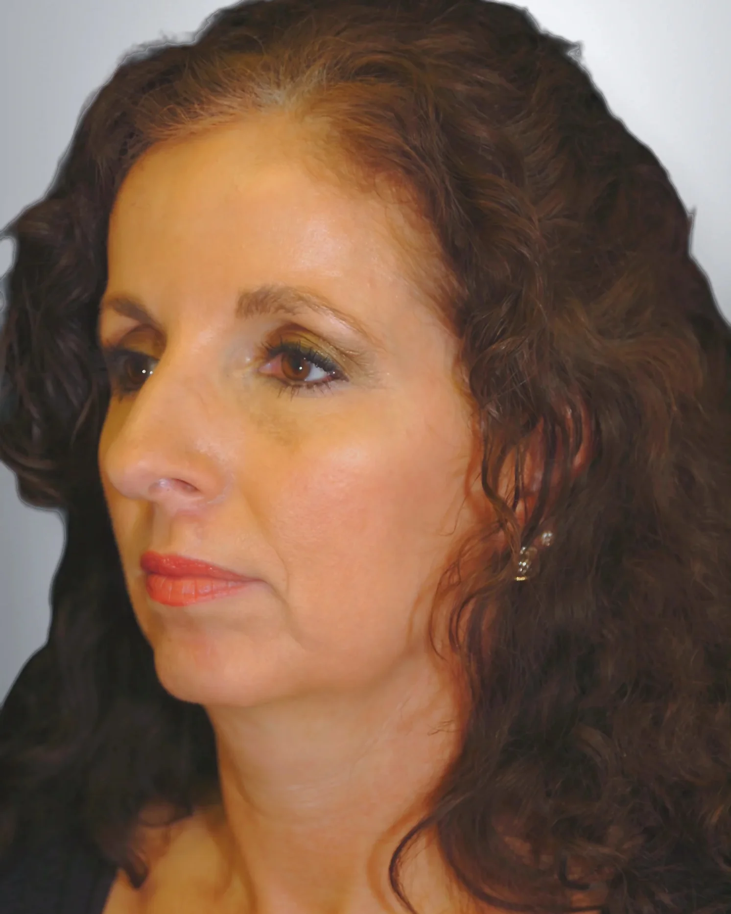 Chin Augmentation + Midface Lift before, Edition Plastic Surgery patient
