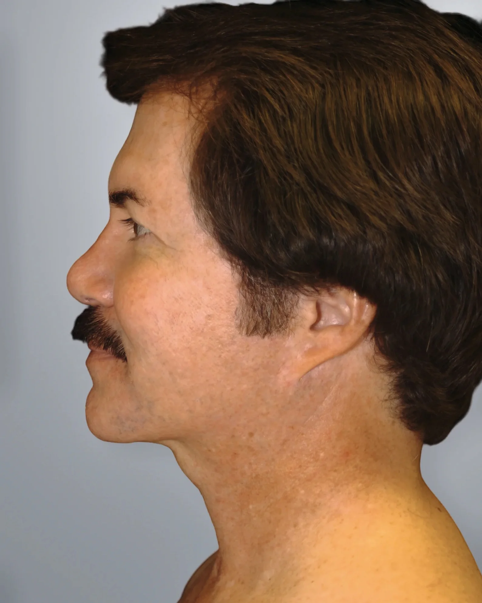 Liposuction after, Edition Plastic Surgery patient