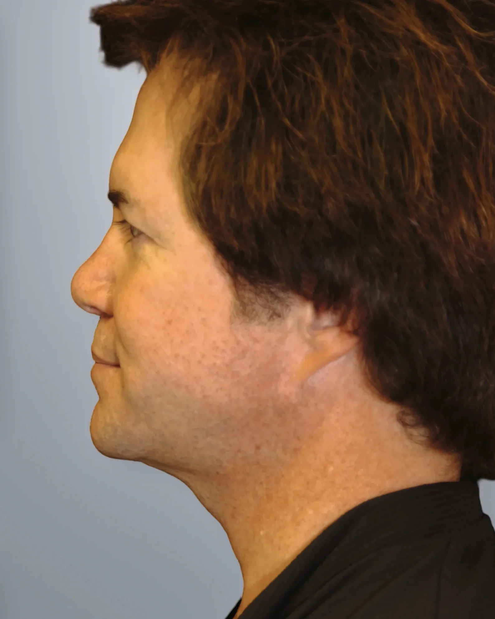 Liposuction before, Edition Plastic Surgery patient