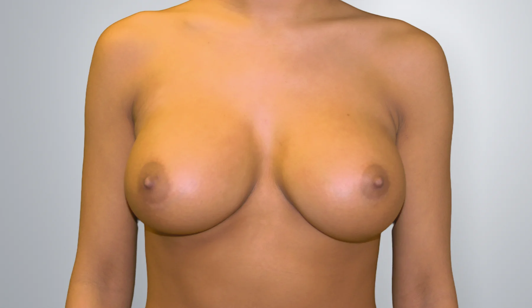 Breast Implant Revision after, Edition Plastic Surgery patient