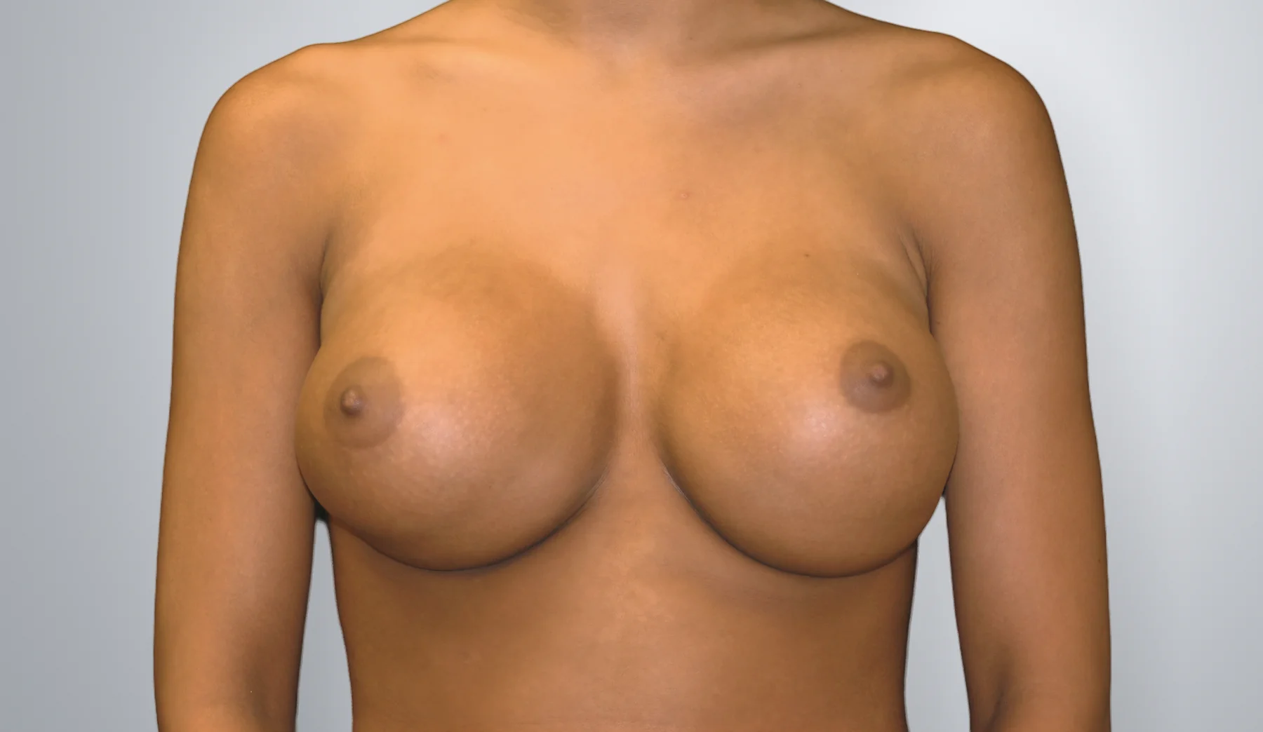 Breast Implant Revision before, Edition Plastic Surgery patient