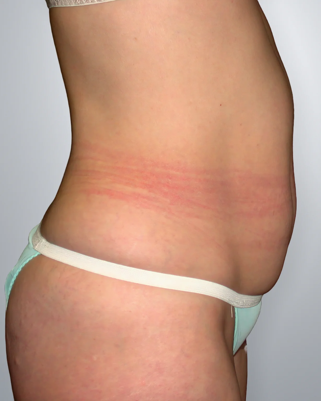 Tummy Tuck before, Edition Plastic Surgery patient