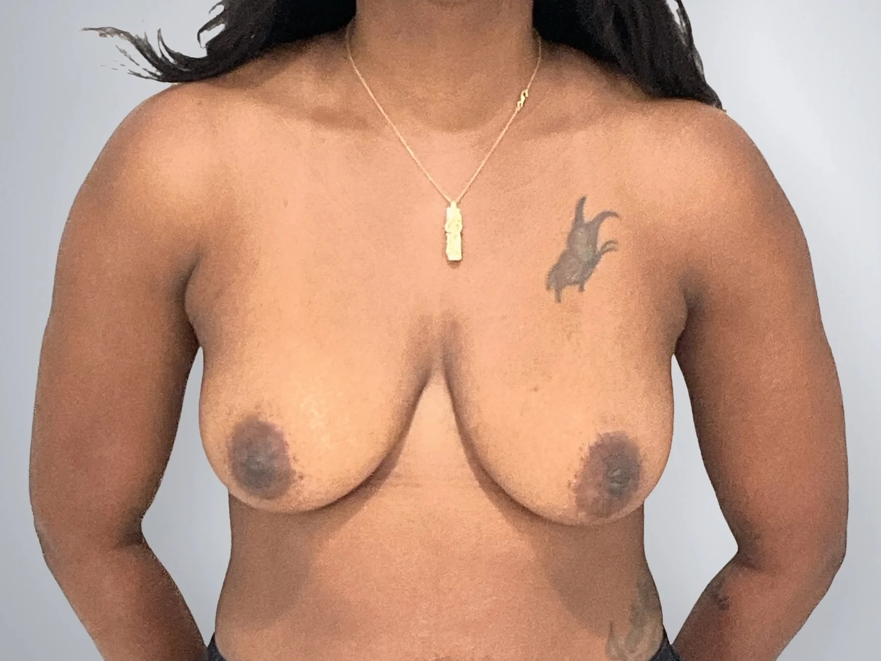 Breast Augmentation before, Edition Plastic Surgery patient