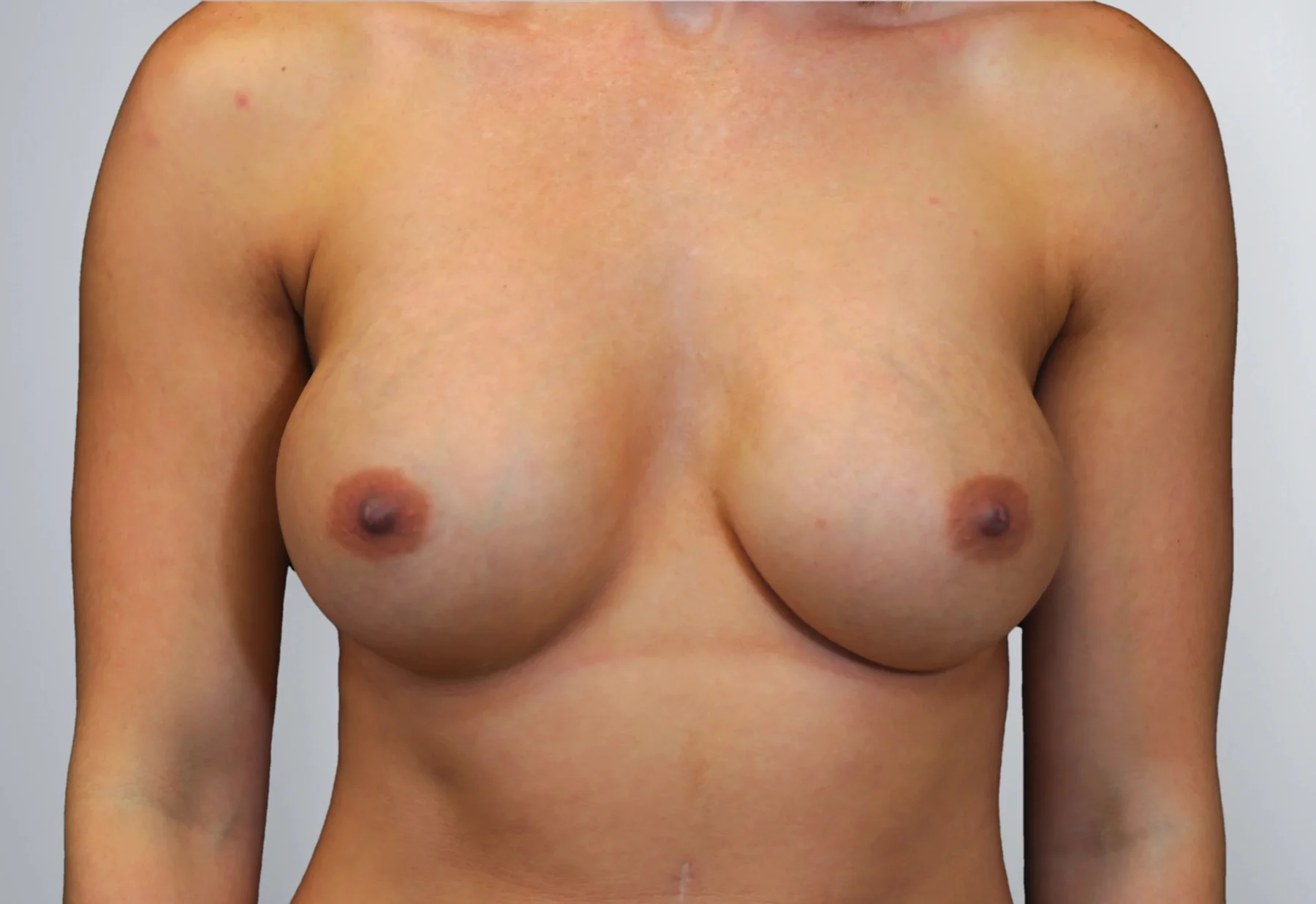 Breast Augmentation after, Edition Plastic Surgery patient