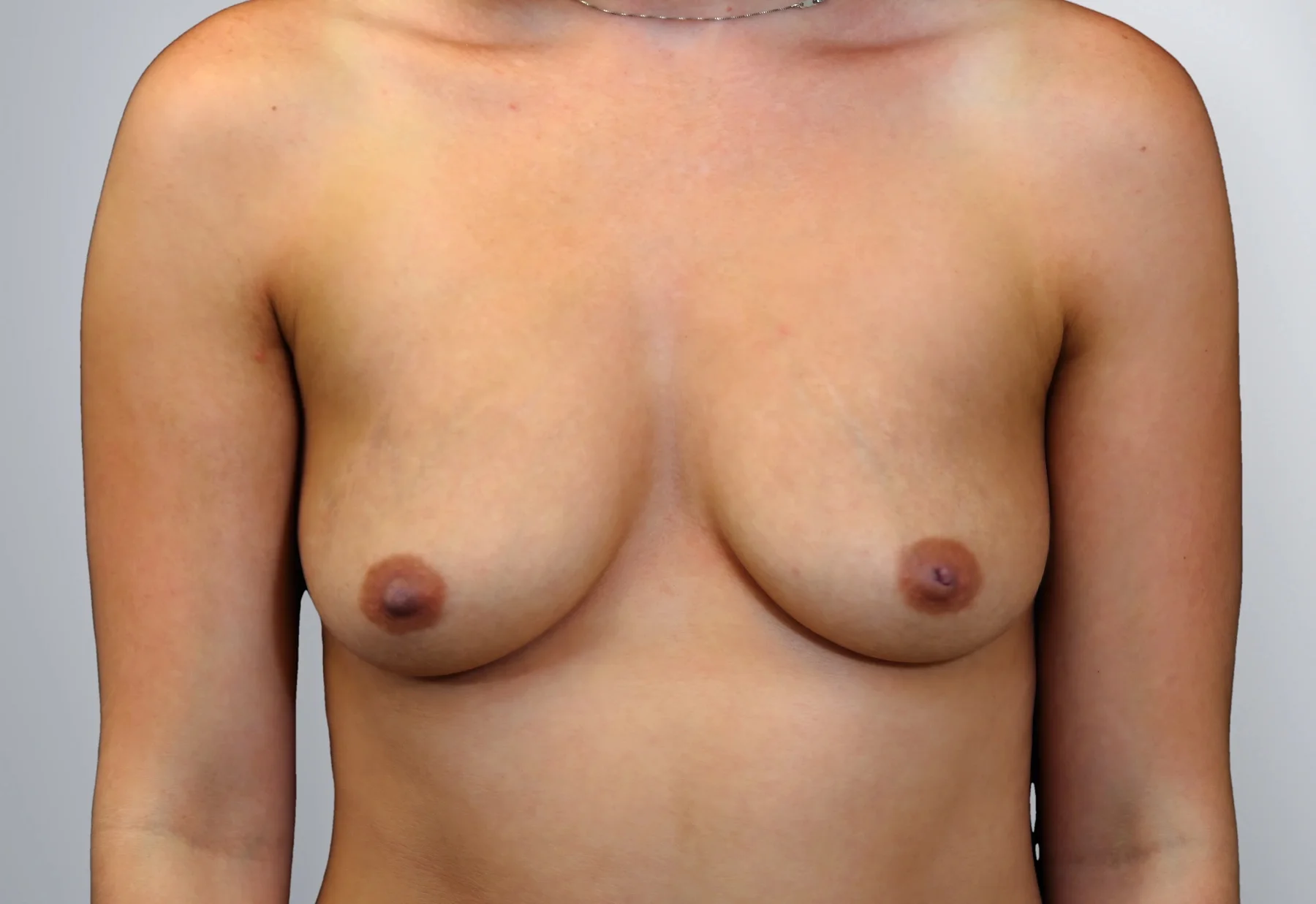 Breast Augmentation before, Edition Plastic Surgery patient